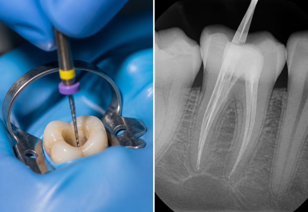 Terapia canalare su un dente isolato con diga e radiografia dei canali