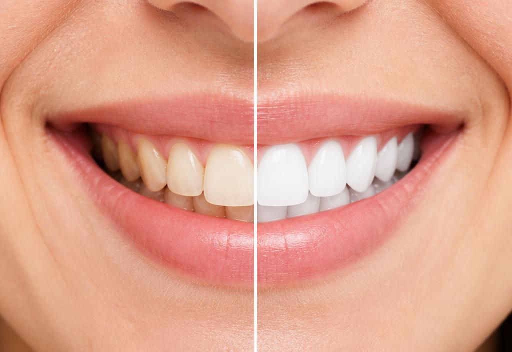 Confronto prima e dopo: denti gialli e denti bianchi